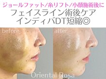 オリエンタルローザ 表参道(Oriental Rosa)/糸リフト術後アフターケアケア◎