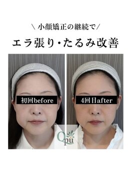 キュープ 北千住店(Qpu)/ビフォーアフター(エラ・たるみ)