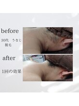 クリオネ(Clione)/後ろ姿から美人に！！襟足脱毛