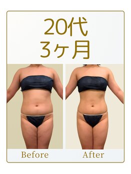キュール(KuhL)/20代痩身ビフォーアフター☆