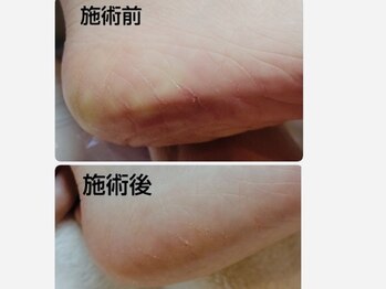 トレボー 桜ヶ丘店/フット角質ケア