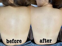 サロン マレ(salon mare)/背中のニキビケア