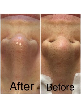 ケイビューティーサロン(K BeautySalon)/★ハイドラフェイシャル★