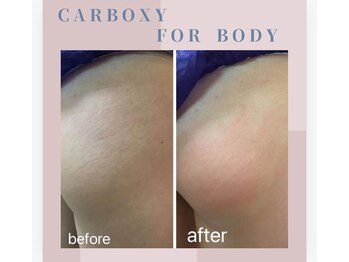 アリー(ALLY)/CARBOXY BODYcare