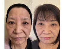 吉宗指圧治療院/ダイヤモンドピールbefore after