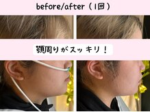 ヨサパーク ベアトリーチェ(YOSA PARK beatrice)/水素吸入でフェイスラインケア！