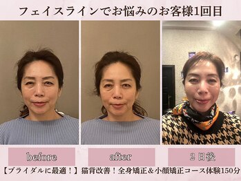 フラン(franc)/リフトアップ＆若々しさアップ