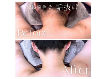 ハピネス 広島並木通り店(Happiness)/うなじ脱毛