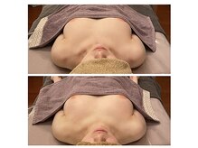 ベンザイ 梅田店(BENZAI)/バストの離れ、下垂