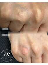 アエ(ae)/スポットクリア