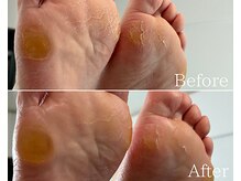 カシェット 広島店(Cachette)/40代女性☆足裏角質ケア90分