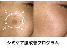 お客様の肌悩みお聞かせください毛穴・シミ・しわ・美肌・癒し