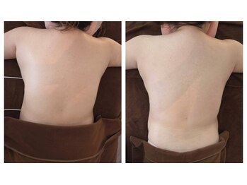 ユイットブランシュ(HUIT blanche)/本気の痩身♪一回目