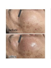 スピカ(Spica)/REVI陶肌トリートメント