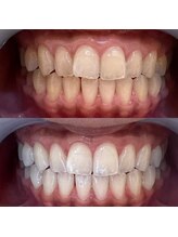 クレン(CLEN)/医療提携ホワイトニング