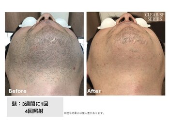 ロカビリー(Rockabilly)/メンズ　ヒゲ脱毛