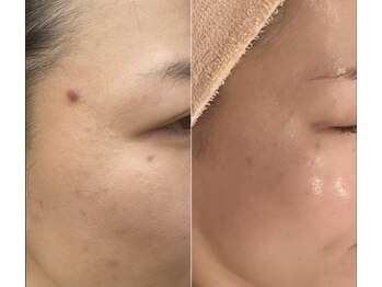 トータルエステティック ジョワイユ(JOYEUX)/とにかく肌荒れで悩んでいた...