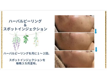 シャトン ボーテ(chaton beaute)/ピーリング&シミ集中ケア♪