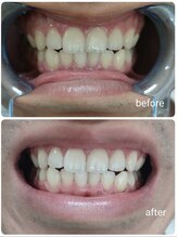 エクシアホワイトニング 沖縄宮里店/お客様ビフォア