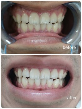 エクシアホワイトニング 沖縄宮里店/お客様ビフォア