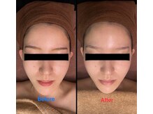 ビタミンスパ 中野店/小顔★施術回数1回