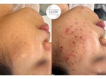 グロウ(GLOW)/ニキビケア/ハーブピーリング