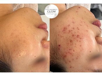 グロウ(GLOW)/ニキビケア/ハーブピーリング