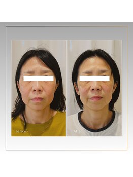 キュララ(KYURARA)/たるみケア気になる年齢肌を改善