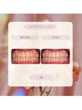 プラスビー 2号店(+b)/ホワイトニングビフォーアフター