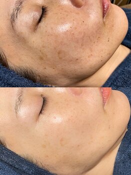 ソリッジ肌管理室/TIPの最新シミケア