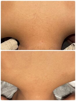 ディオーネ 春日井勝川店(Dione)/背中+うなじ脱毛