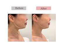 造顔 ビフォーアフター日替わり写真【麻布十番/小顔/症例No.1】