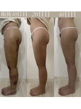 ダウンタイムオンニ(DowntimeOnni)/急性期のダウタイムはケア次第