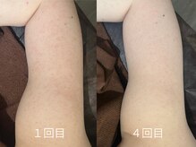 エミルカ 日の出平井店(EMILUCA)/ブツブツ気になる二の腕も綺麗に