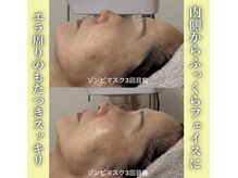 ハニエル(Haniel)/ゾンビマスク症例