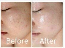 サロン ド ヒノキ(Salon de HINOKI)/肌質改善ハーブピーリング