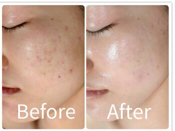 サロン ド ヒノキ(Salon de HINOKI)/肌質改善ハーブピーリング