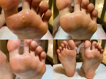 ビサンテ サロン/フットケア,角質ケア,魚の目-2