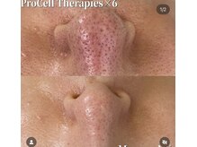 お肌の凹凸や、毛穴の開き、傷、赤ら顔etc全ての肌悩みに対応