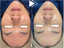 リシェス(Richesse)/ワイコ水光ピール★初回¥9990