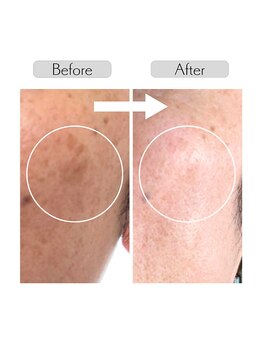 イチキュービー 仙台駅前東口店(19B)/IPL光フェイシャル