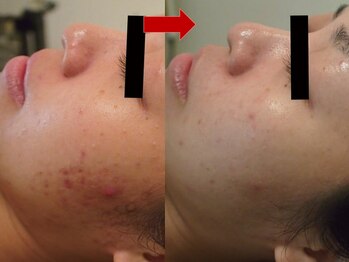 ブリリアン デイスパ 阪急西宮ガーデンズ店(BRILLIAN DAYSPA)/水光ピーリング