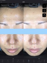 ウニ(uni)/オーダーメイド肌管理の症例です