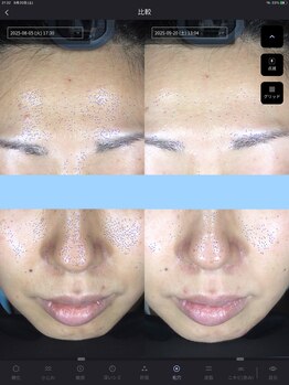 ウニ(uni)/オーダーメイド肌管理の症例です