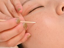 リシェル(Richelle)の雰囲気（はがれる最新シミケア/短期改善/専門サロンにご相談ください）