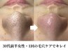 【毛穴ケア】鼻黒ずみ・詰まり・角栓に｜毛穴を一度整えたい方へ◎15800円⇒