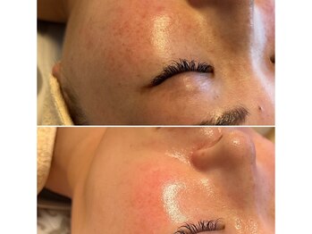 ココビ(COCOVi)の写真/最新マシンプラズマニア導入サロン！諦めていたくシミやくすみ本気の改善☆施術後の変化をご体験ください◎