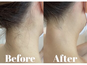 バリット 苦楽園(VALLITTO)/ワックス脱毛/うなじワックス