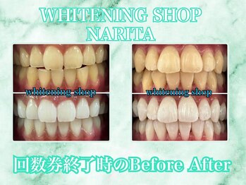 ホワイトニングショップ 成田店/【Before&After】