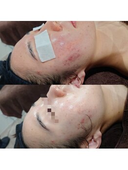 ボーソリューション(Beau-Solution)/【20代　赤みニキビケア】